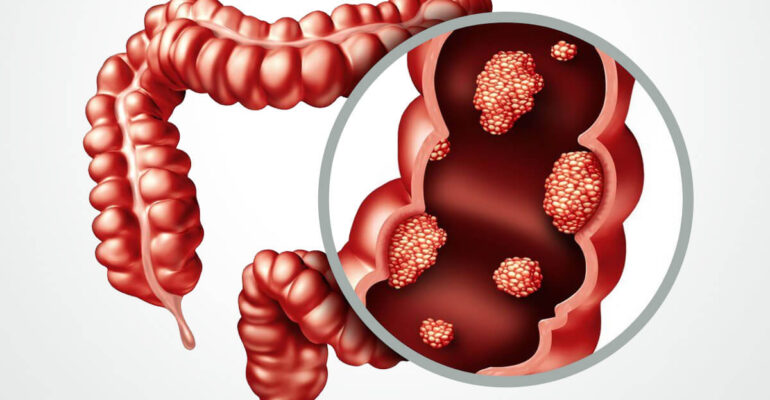 Types, Symptoms and Screening of Intestine Cancer