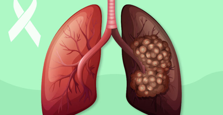 Lung Cancer Awareness – Symptoms, Stages and Treatment