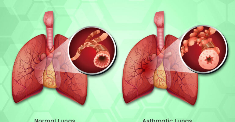 Causes of Asthma and Best Practices for Prevention