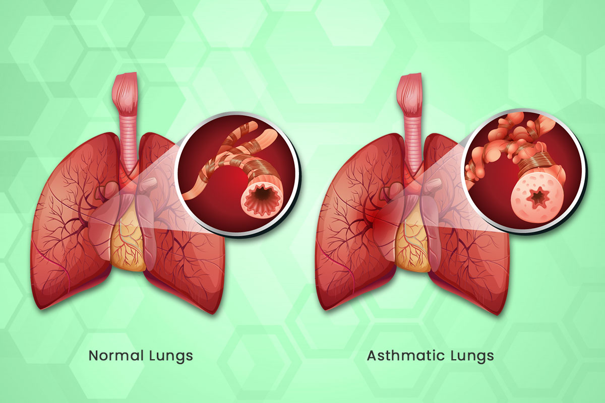 Causes of asthma