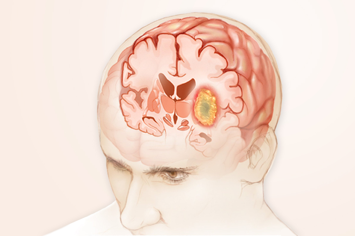 Brain Tumors – Common Symptoms and Treatments