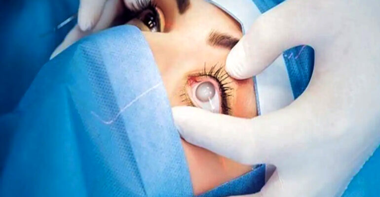 Cataract Surgery FAQs – All You Need to Know Beforehand